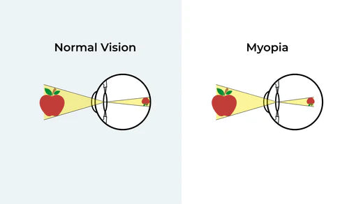 What Is Hyperopia? (Long Sightedness)